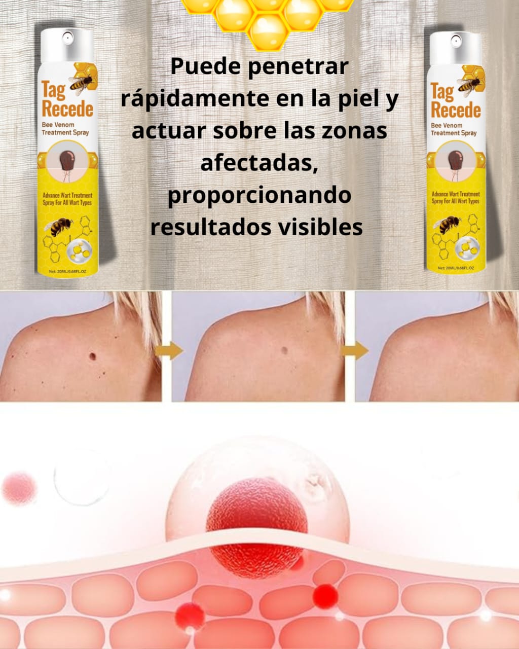 ¡Dile adiós a las verrugas de forma rápida y segura!